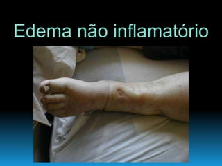 Edema não inflamatório
 