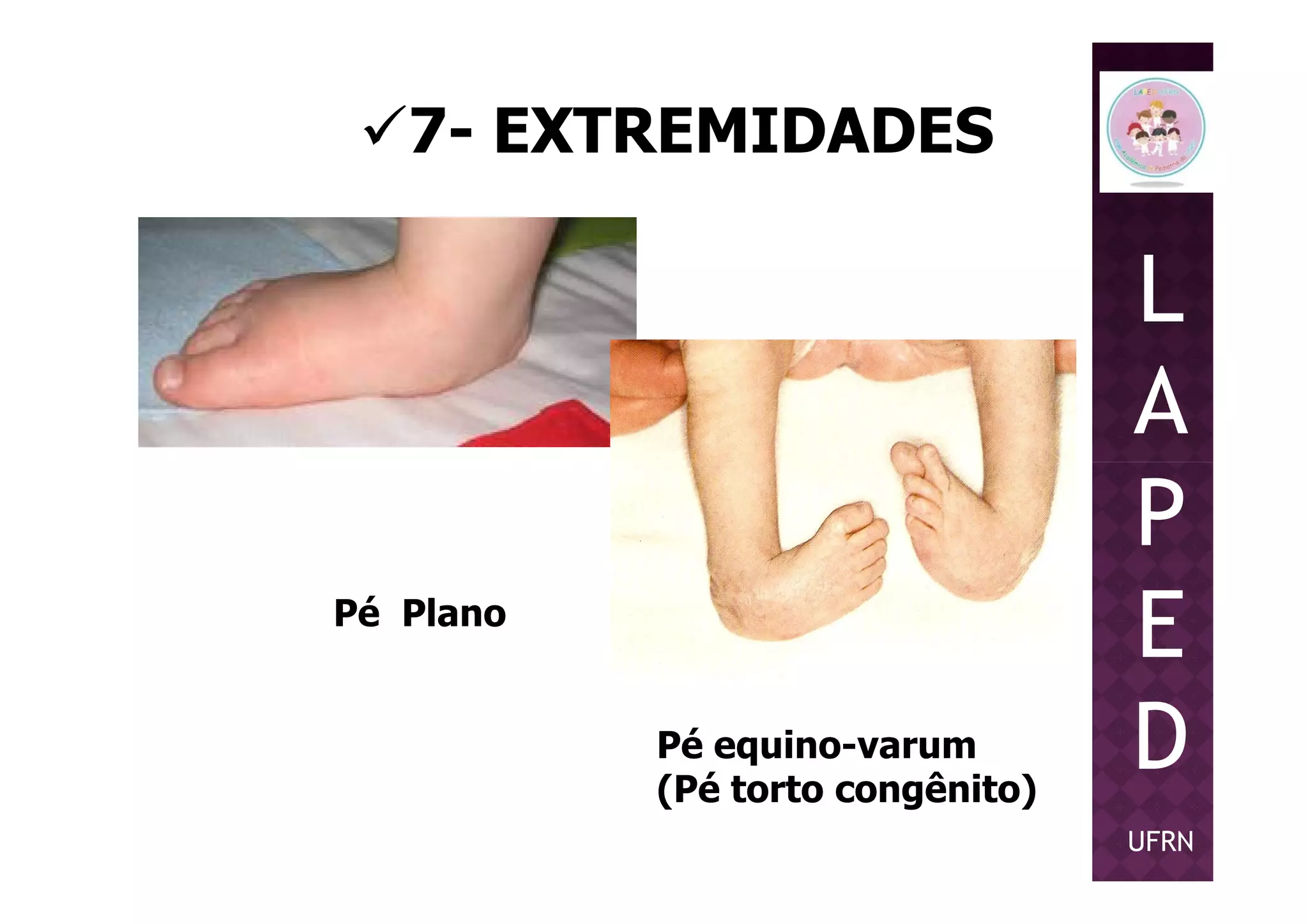 7- EXTREMIDADES
L
A
P
Pé Plano
Pé equino-varum
(Pé torto congênito)
P
E
D
UFRN
 