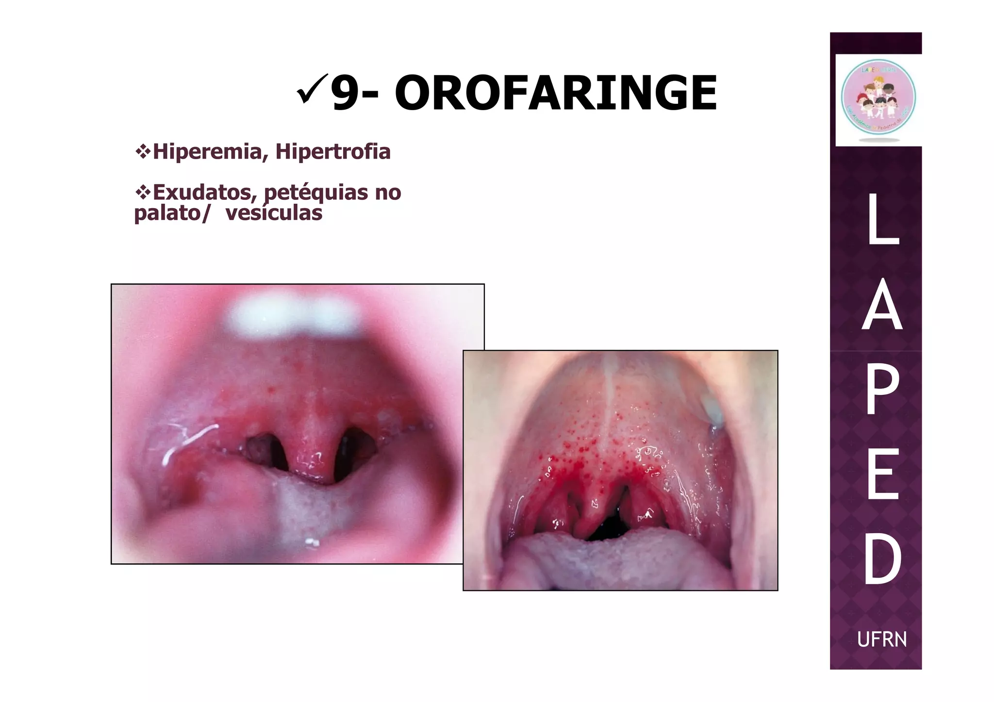 9- OROFARINGE
Hiperemia, Hipertrofia
Exudatos, petéquias no
palato/ vesículas
L
A
PP
E
D
UFRN
 
