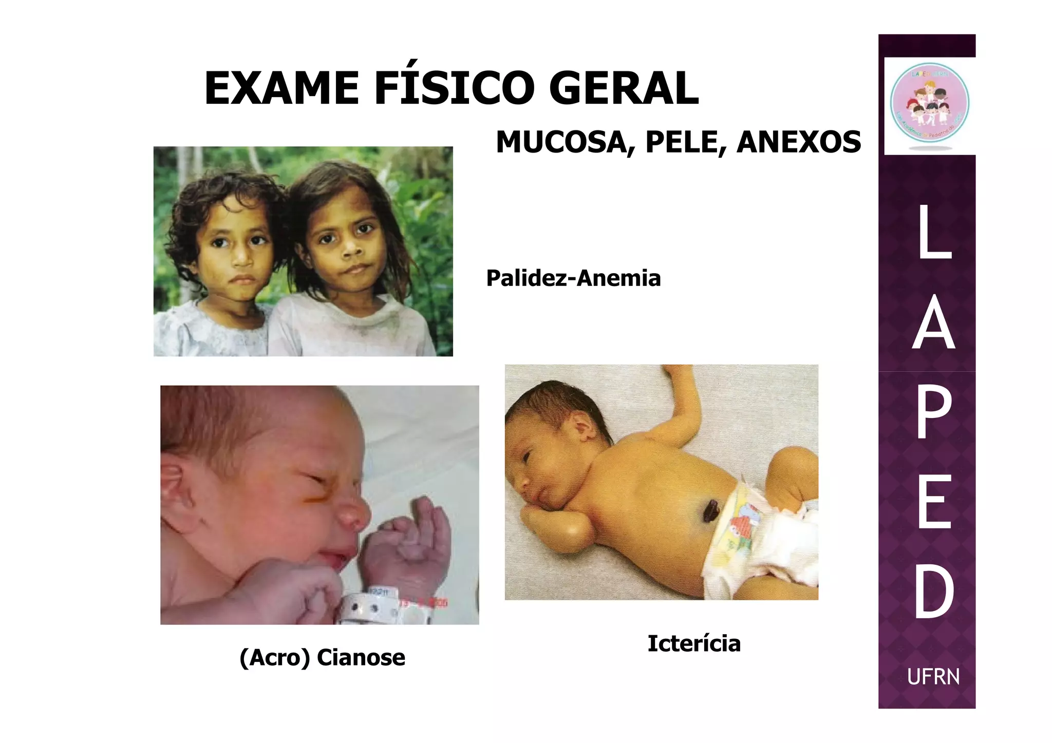 EXAME FÍSICO GERAL
MUCOSA, PELE, ANEXOS
Palidez-Anemia
L
A
P
(Acro) Cianose
Icterícia
P
E
D
UFRN
 