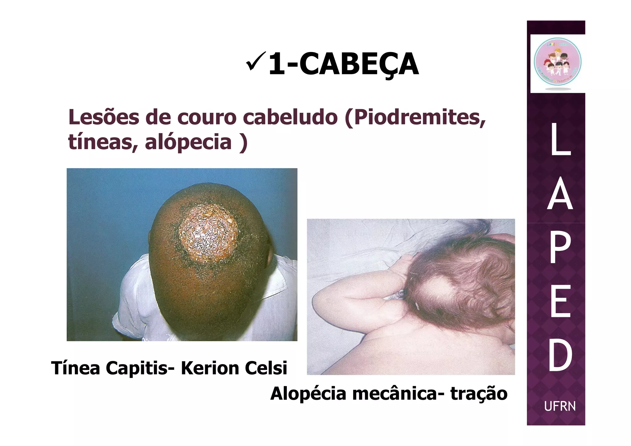 1-CABEÇA
Lesões de couro cabeludo (Piodremites,
tíneas, alópecia ) L
A
PP
E
D
UFRN
Tínea Capitis- Kerion Celsi
Alopécia mecânica- tração
 