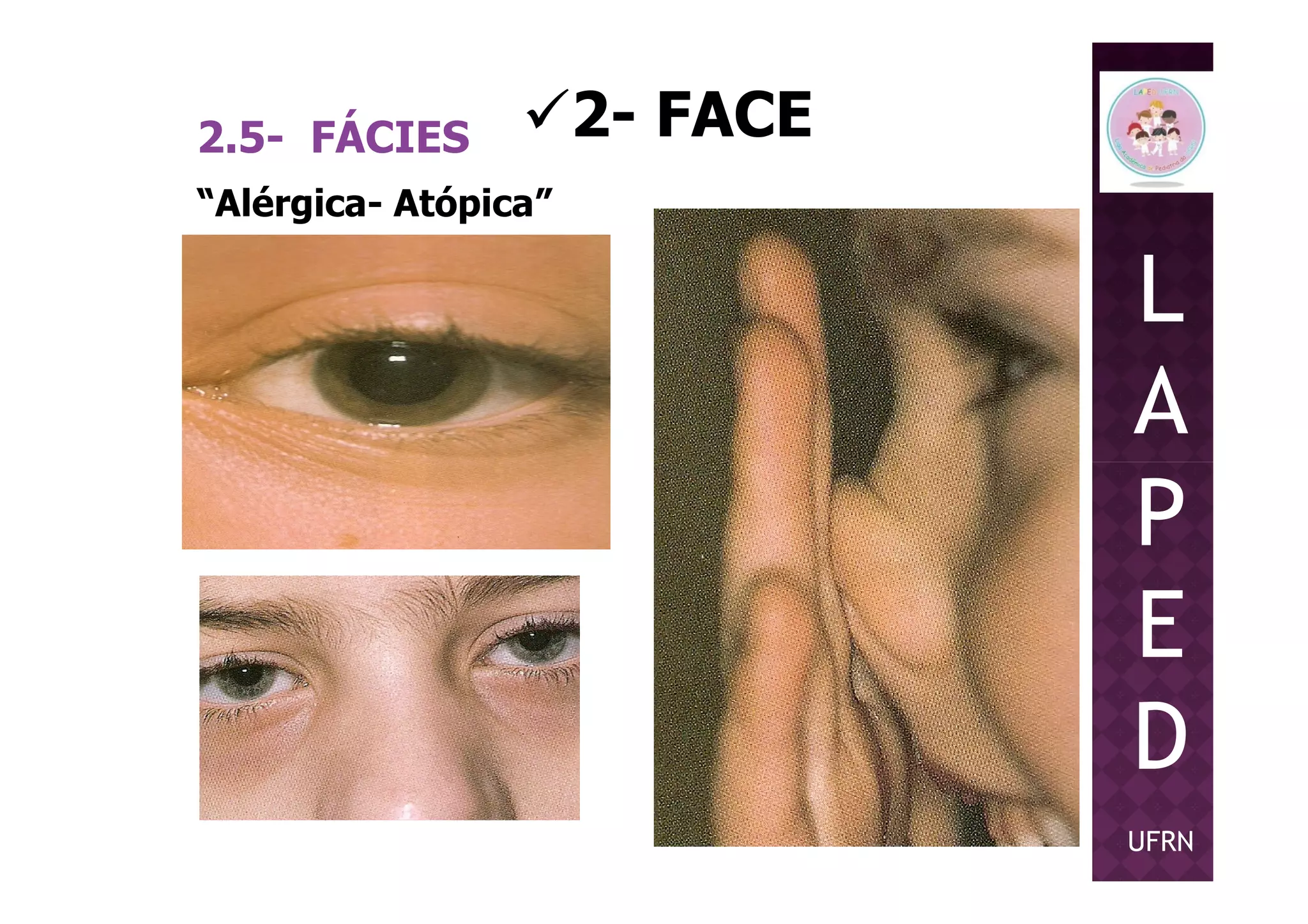 2- FACE2.5- FÁCIES
L
A
P
“Alérgica- Atópica”
P
E
D
UFRN
 