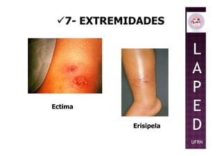 7- EXTREMIDADES
L
A
P
Erisipela
Ectima
P
E
D
UFRN
 