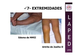 7- EXTREMIDADES
L
A
P
Edema de MMII
Artrite de Joelho D
P
E
D
UFRN
 