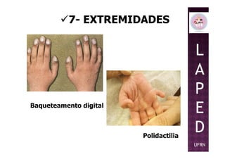 7- EXTREMIDADES
L
A
P
Baqueteamento digital
Polidactilia
P
E
D
UFRN
 