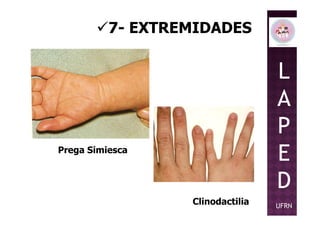 7- EXTREMIDADES
L
A
P
Prega Simiesca
Clinodactilia
P
E
D
UFRN
 