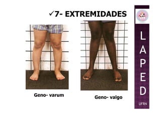 7- EXTREMIDADES
L
A
P
Geno- valgoGeno- varum
P
E
D
UFRN
 