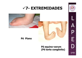 7- EXTREMIDADES
L
A
P
Pé Plano
Pé equino-varum
(Pé torto congênito)
P
E
D
UFRN
 