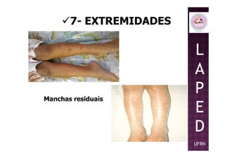 7- EXTREMIDADES
L
A
PManchas residuais
P
E
D
UFRN
 
