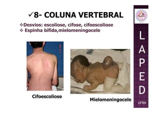 8- COLUNA VERTEBRAL
Desvios: escoliose, cifose, cifoescoliose
Espinha bífida,mielomeningocele
L
A
P
Cifoescoliose
Mielomeningocele
P
E
D
UFRN
 