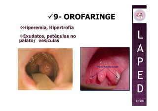 9- OROFARINGE
Hiperemia, Hipertrofia
Exudatos, petéquias no
palato/ vesículas
L
A
PP
E
D
UFRN
 