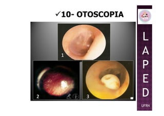 10- OTOSCOPIA
L
A
PP
E
D
UFRN
 
