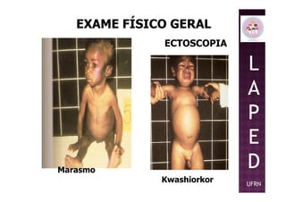 EXAME FÍSICO GERAL
ECTOSCOPIA
L
A
P
Marasmo
Kwashiorkor
P
E
D
UFRN
 