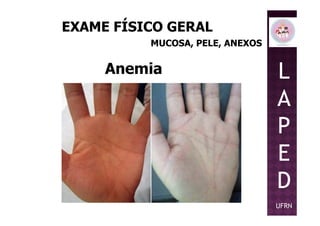 EXAME FÍSICO GERAL
MUCOSA, PELE, ANEXOS
Anemia L
A
PP
E
D
UFRN
 
