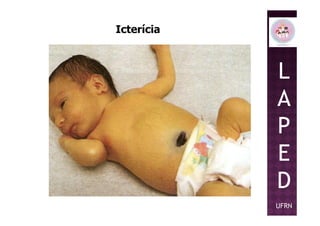 L
A
P
Icterícia
P
E
D
UFRN
 