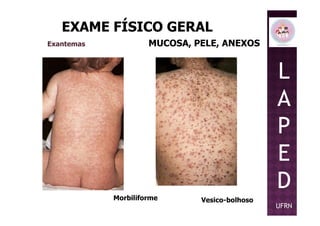 EXAME FÍSICO GERAL
MUCOSA, PELE, ANEXOSExantemas
L
A
P
Morbiliforme Vesico-bolhoso
P
E
D
UFRN
 