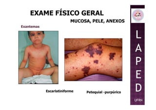 EXAME FÍSICO GERAL
MUCOSA, PELE, ANEXOS
Exantemas
L
A
P
Escarlatiniforme Petequial -purpúrico
P
E
D
UFRN
 