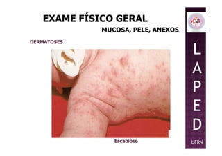 EXAME FÍSICO GERAL
MUCOSA, PELE, ANEXOS
DERMATOSES
L
A
P
Escabiose
P
E
D
UFRN
 