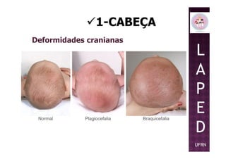 1-CABEÇA
Deformidades cranianas
L
A
PP
E
D
UFRN
 
