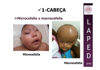 1-CABEÇA
Microcefalia x macrocefalia
L
A
P
Microcefalia
Macrocefalia
P
E
D
UFRN
 
