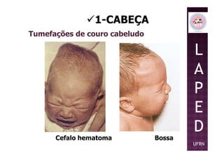 1-CABEÇA
Tumefações de couro cabeludo
L
A
P
Cefalo hematoma Bossa
P
E
D
UFRN
 