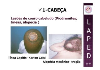 1-CABEÇA
Lesões de couro cabeludo (Piodremites,
tíneas, alópecia ) L
A
PP
E
D
UFRN
Tínea Capitis- Kerion Celsi
Alopécia mecânica- tração
 