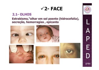 2- FACE
2.1- OLHOS
Estrabismo,”olhar em sol poente (hidrocefalia),
secreção, hemorragias , epicanto L
A
PP
E
D
UFRN
 