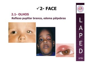 2- FACE
2.1- OLHOS
Reflexo puplilar branco, edema pálpebras
L
A
PP
E
D
UFRN
 