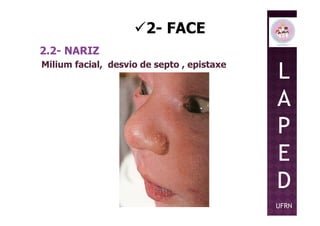 2- FACE
2.2- NARIZ
Milium facial, desvio de septo , epistaxe
L
A
PP
E
D
UFRN
 