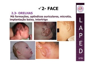 2- FACE
2.3- ORELHAS
Má formações, apêndices auriculares, microtia,
implantação baixa, intertrigo
L
A
PP
E
D
UFRN
 