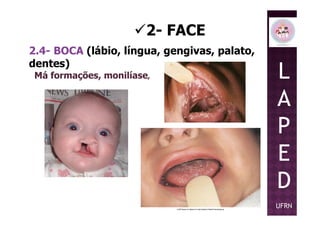 2- FACE
2.4- BOCA (lábio, língua, gengivas, palato,
dentes)
Má formações, monilíase, L
A
PP
E
D
UFRN
 