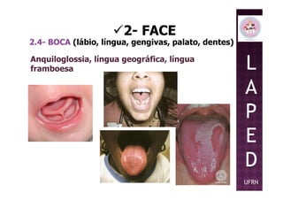 2- FACE
2.4- BOCA (lábio, língua, gengivas, palato, dentes)
Anquiloglossia, língua geográfica, língua
framboesa L
A
PP
E
D
UFRN
 