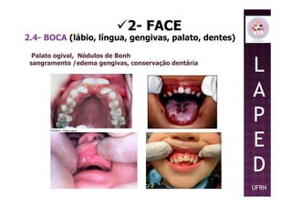 2- FACE
2.4- BOCA (lábio, língua, gengivas, palato, dentes)
Palato ogival, Nódulos de Bonh
sangramento /edema gengivas, conservação dentária
L
A
PP
E
D
UFRN
 