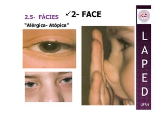 2- FACE2.5- FÁCIES
L
A
P
“Alérgica- Atópica”
P
E
D
UFRN
 