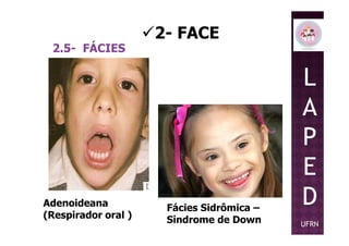 2- FACE
2.5- FÁCIES
L
A
PP
E
D
UFRN
Adenoideana
(Respirador oral )
Fácies Sidrômica –
Sindrome de Down
 
