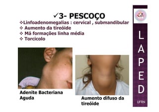 Linfoadenomegalias : cervical , submandibular
Aumento da tireóide
Má formações linha média
Torcicolo
3- PESCOÇO
L
A
PP
E
D
UFRN
Adenite Bacteriana
Aguda Aumento difuso da
tireóide
 