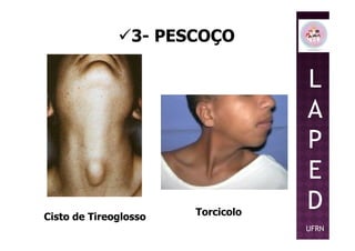 3- PESCOÇO
L
A
PP
E
D
UFRN
Cisto de Tireoglosso Torcicolo
 