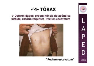 4- TÓRAX
Deformidades: proeminência do apêndice
xifóide, rosário raquítico, Pectum escavatum
L
A
P
“Pectum escavatum”
P
E
D
UFRN
 