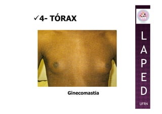 4- TÓRAX
L
A
P
Ginecomastia
P
E
D
UFRN
 