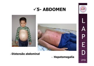 5- ABDOMEN
L
A
P
- Distensão abdominal
- Hepatomegalia
P
E
D
UFRN
 