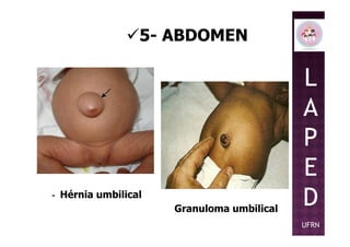 5- ABDOMEN
L
A
P
- Hérnia umbilical
Granuloma umbilical
P
E
D
UFRN
 