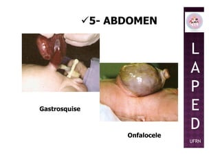 5- ABDOMEN
L
A
P
Onfalocele
Gastrosquise
P
E
D
UFRN
 