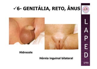 6- GENITÁLIA, RETO, ÂNUS
L
A
P
Hidrocele
Hérnia inguinal bilateral
P
E
D
UFRN
 