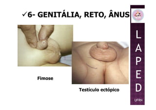 6- GENITÁLIA, RETO, ÂNUS
L
A
P
Fimose
Testículo ectópico
P
E
D
UFRN
 