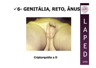 6- GENITÁLIA, RETO, ÂNUS
L
A
P
Criptorquidia a D
P
E
D
UFRN
 