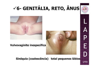 6- GENITÁLIA, RETO, ÂNUS
L
A
P
Vulvovaginite inespecífica
Sinéquia (coalescência) total pequenos lábios
P
E
D
UFRN
 