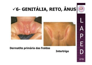 6- GENITÁLIA, RETO, ÂNUS
L
A
P
Dermatite primária das fraldas
Intertrigo
P
E
D
UFRN
 