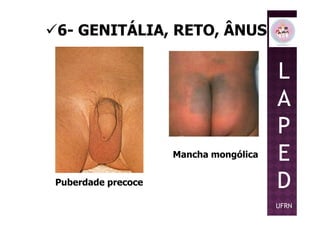 6- GENITÁLIA, RETO, ÂNUS
L
A
P
Puberdade precoce
Mancha mongólica
P
E
D
UFRN
 