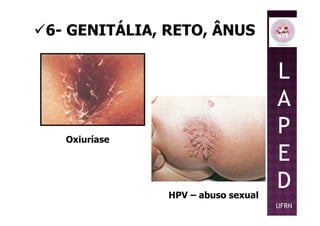 6- GENITÁLIA, RETO, ÂNUS
L
A
POxiuríase
HPV – abuso sexual
P
E
D
UFRN
 