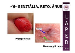 6- GENITÁLIA, RETO, ÂNUS
L
A
P
Prolapso retal
Fissuras ,plicomas
P
E
D
UFRN
 